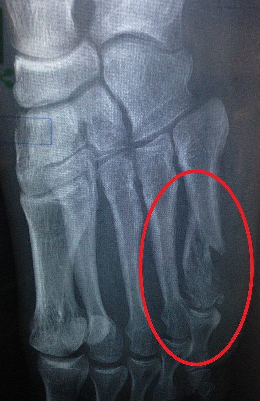 fracture.jpg